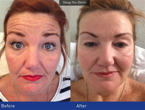 anti-wrinkle treatment carlisle